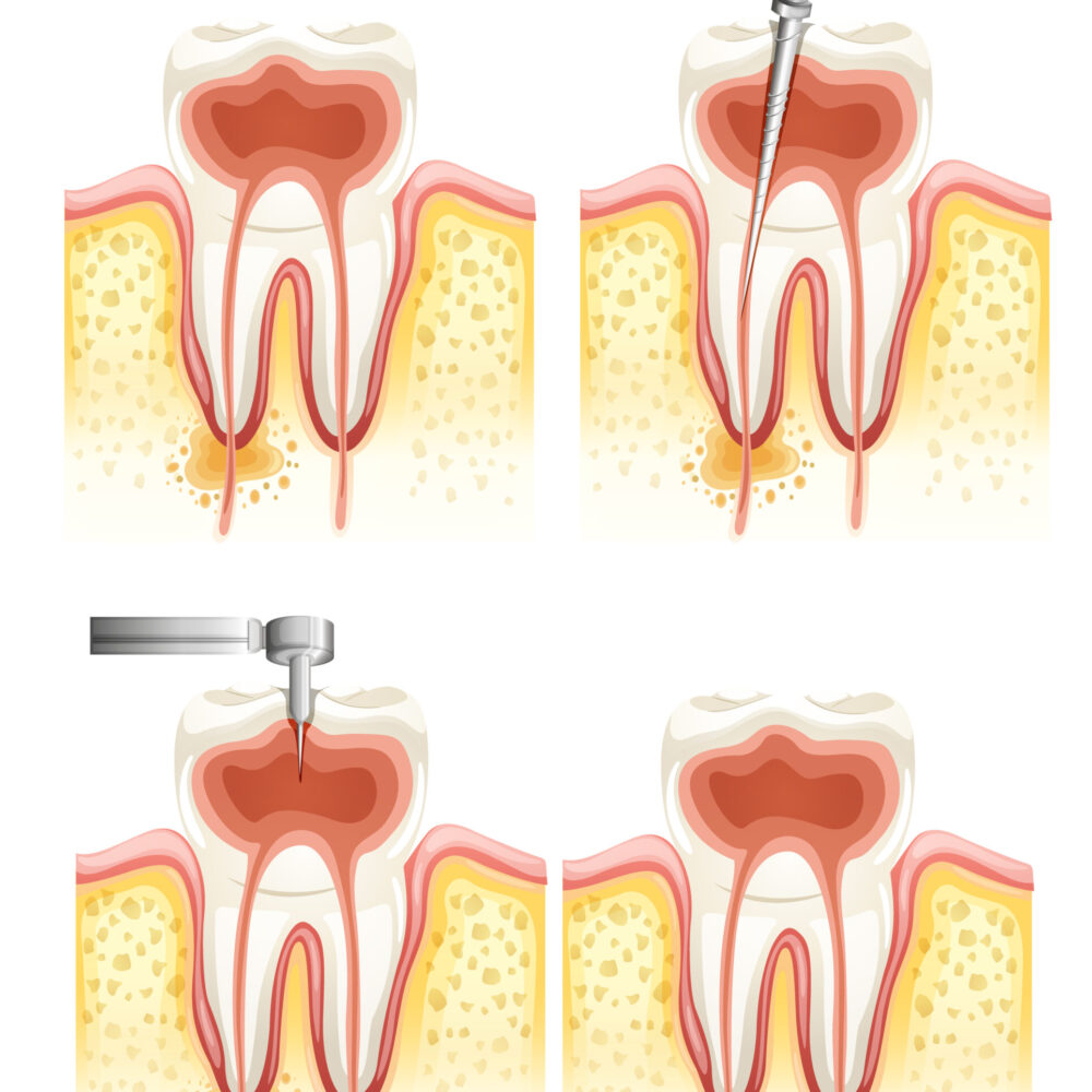 Illustration of a Dental root canal deterioration on a white background
